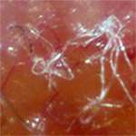 Morgellons