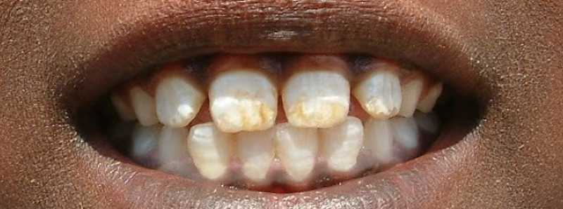 L'eccesso di fluoro danneggia lo smalto dei denti