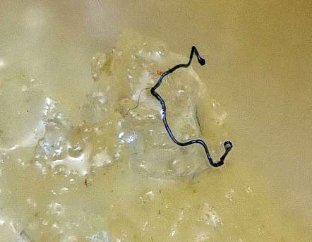 Morgellons