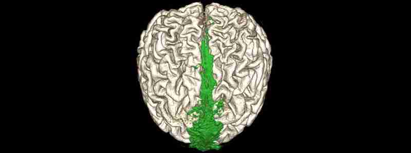 Come il cervello elimina i propri scarti