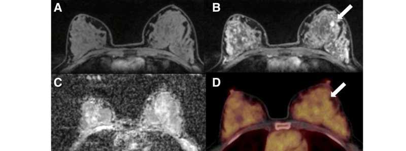 Nuovi biomarcatori di imaging del carcinoma mammario