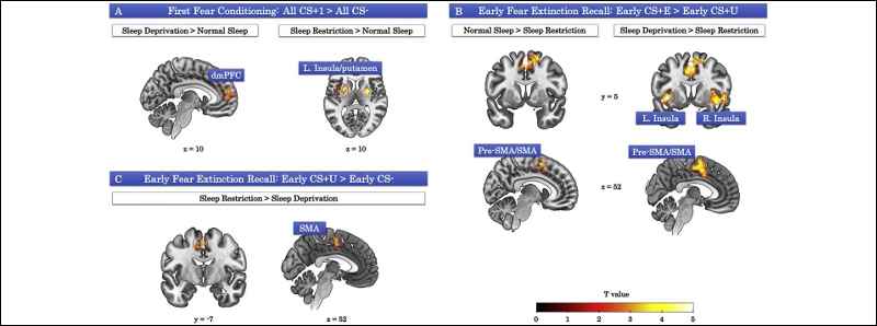 La perdita di sonno dirotta l'attività del cervello