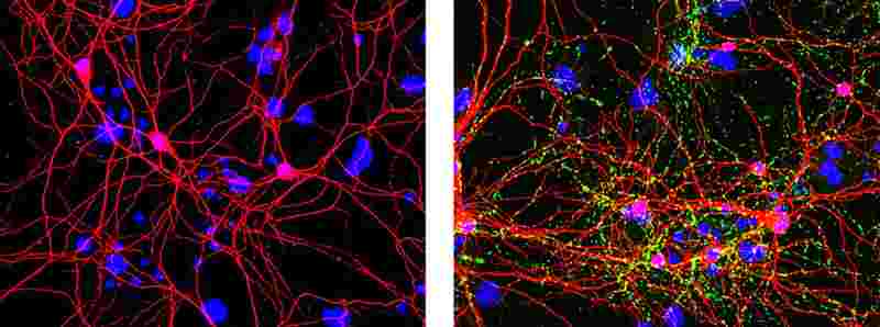 Cellule NK per fermare il morbo di Parkinson